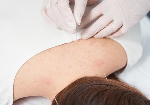 Close-up of acupuncture needles inserted into a patient’s back.
